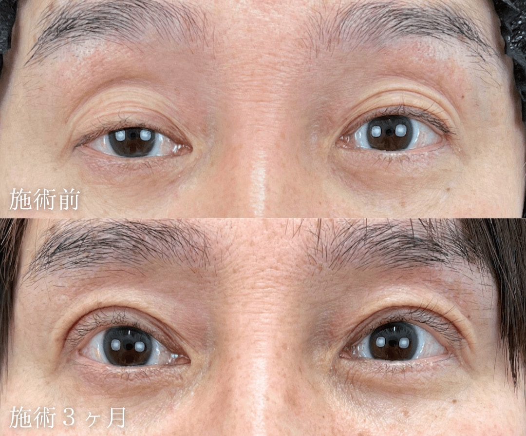 50代男性「まぶたが重く、左右差も気になる」